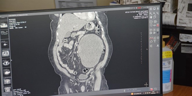 Karın ağrısı şikayetiyle gitti, böbreğinden 23 santimlik kist çıktı